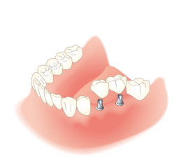 部分入れ歯（義歯）→インプラント