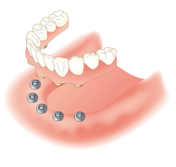 総入れ歯（義歯）→インプラント