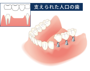 ブリッジ→インプラント