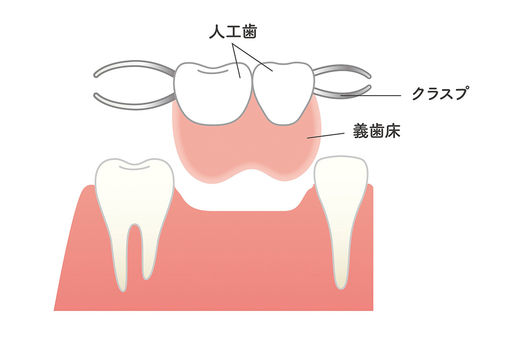 部分入れ歯（義歯）