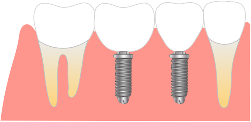 インプラント（ブリッジ）